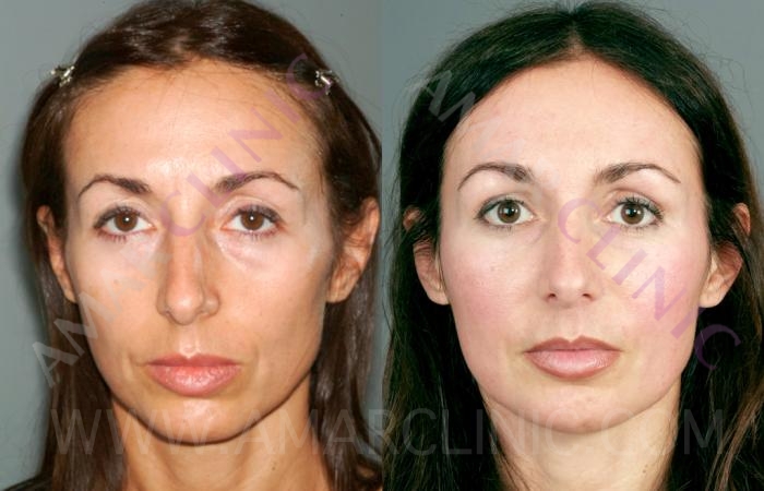 consumirse Ostentoso Fraternidad Rejuvenecimiento Facial Sin Cirugia FAMI -Clínica estética Marbella -  Cirugía estética Marbella