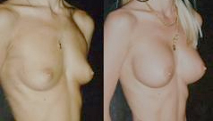 Enlargement of the breast size